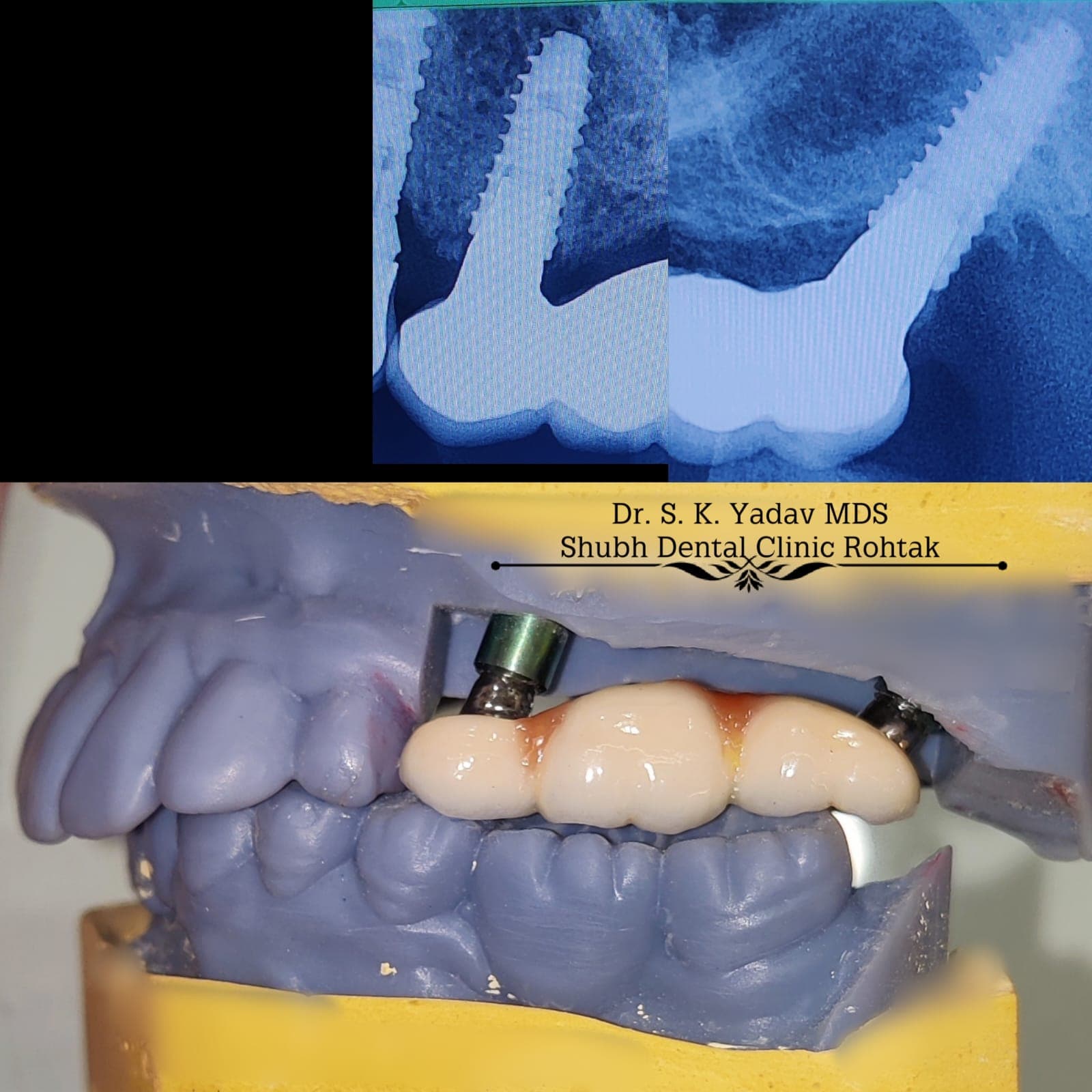 Implant Case #1
