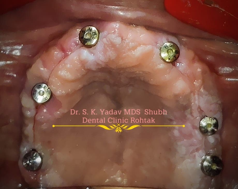 Implant Case #2