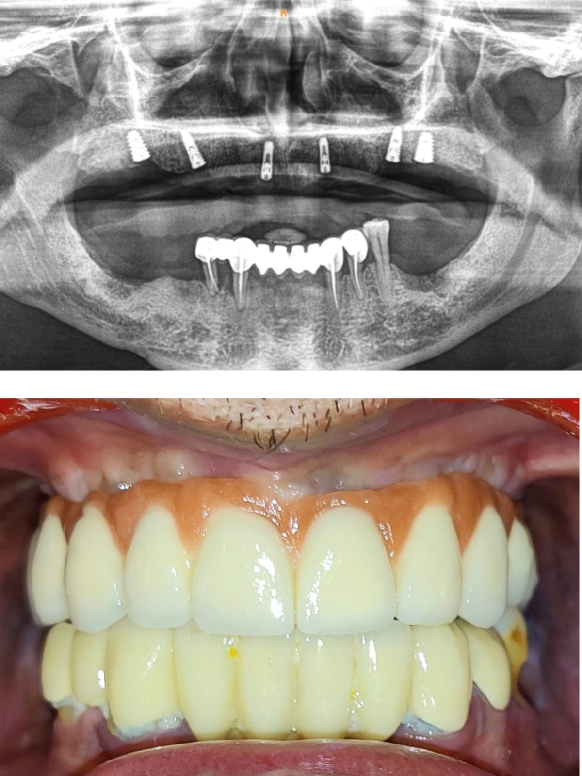 Implant Case #3