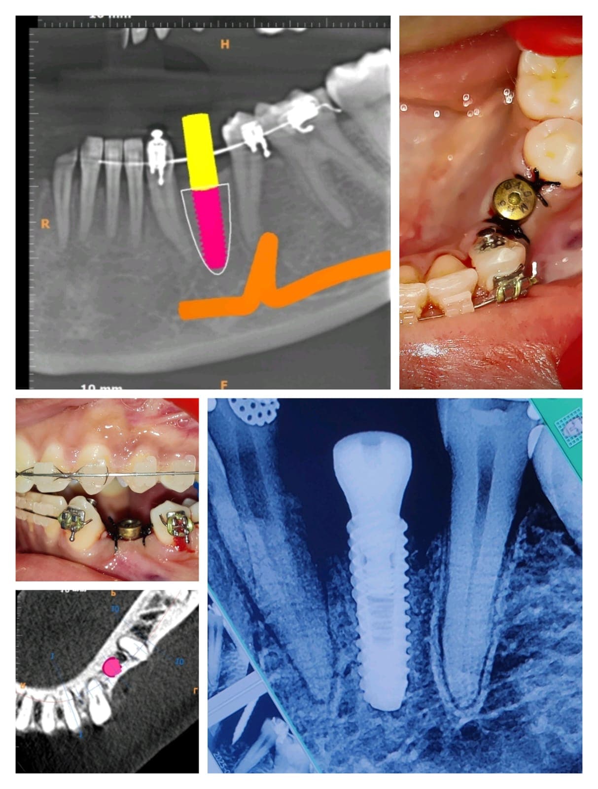 Implant Case #4
