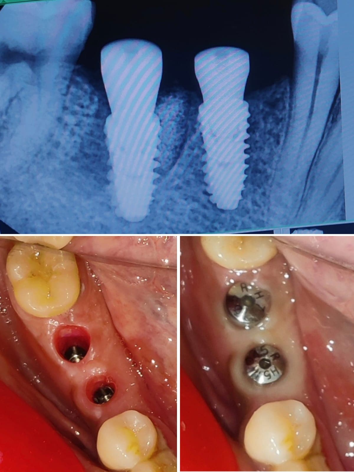 Implant Case #5