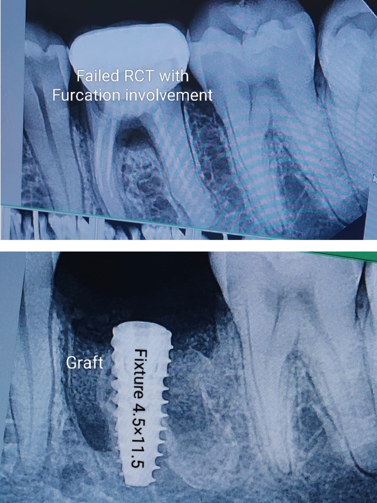 Implant Case #6