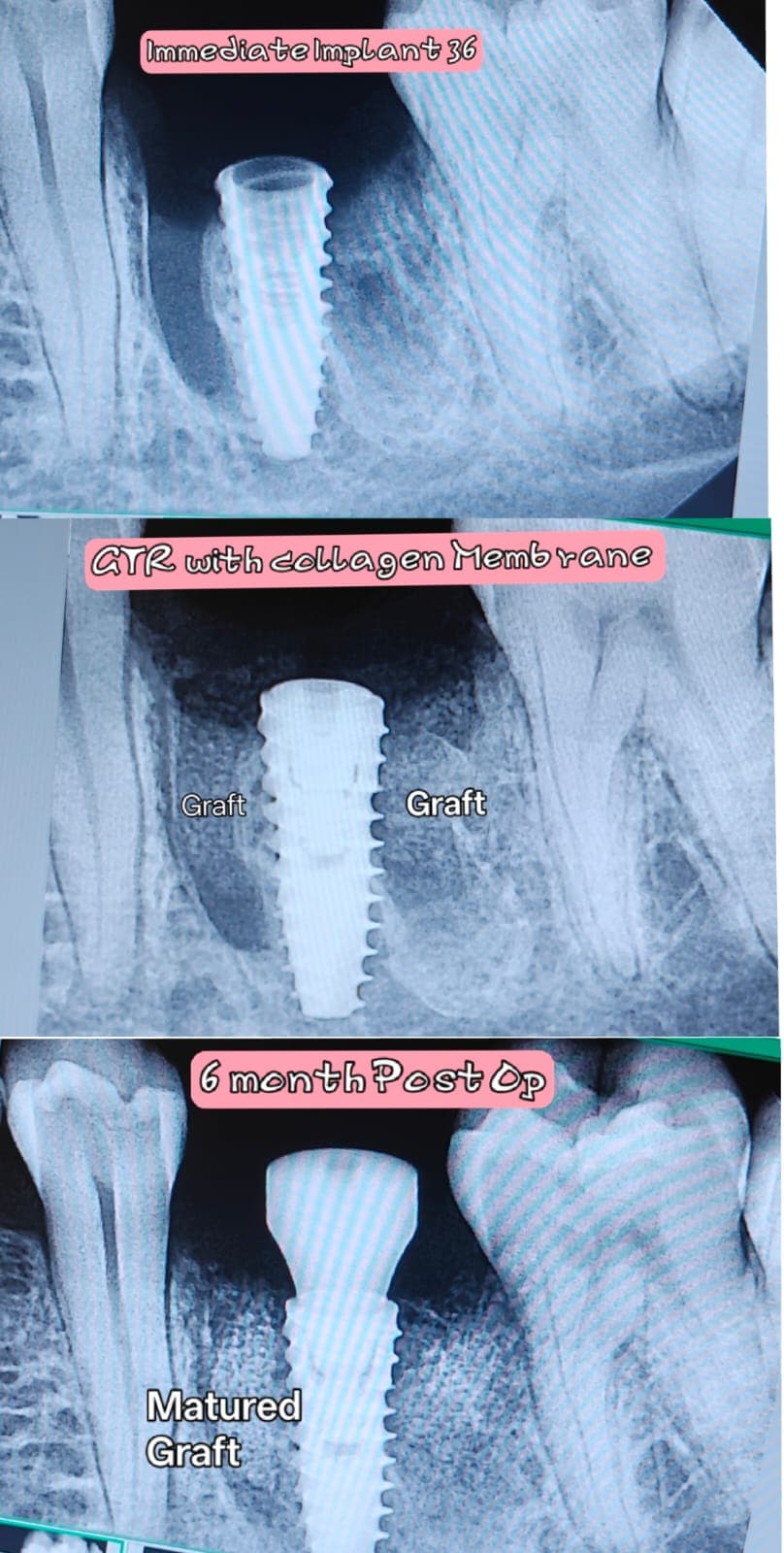 Implant Case #8