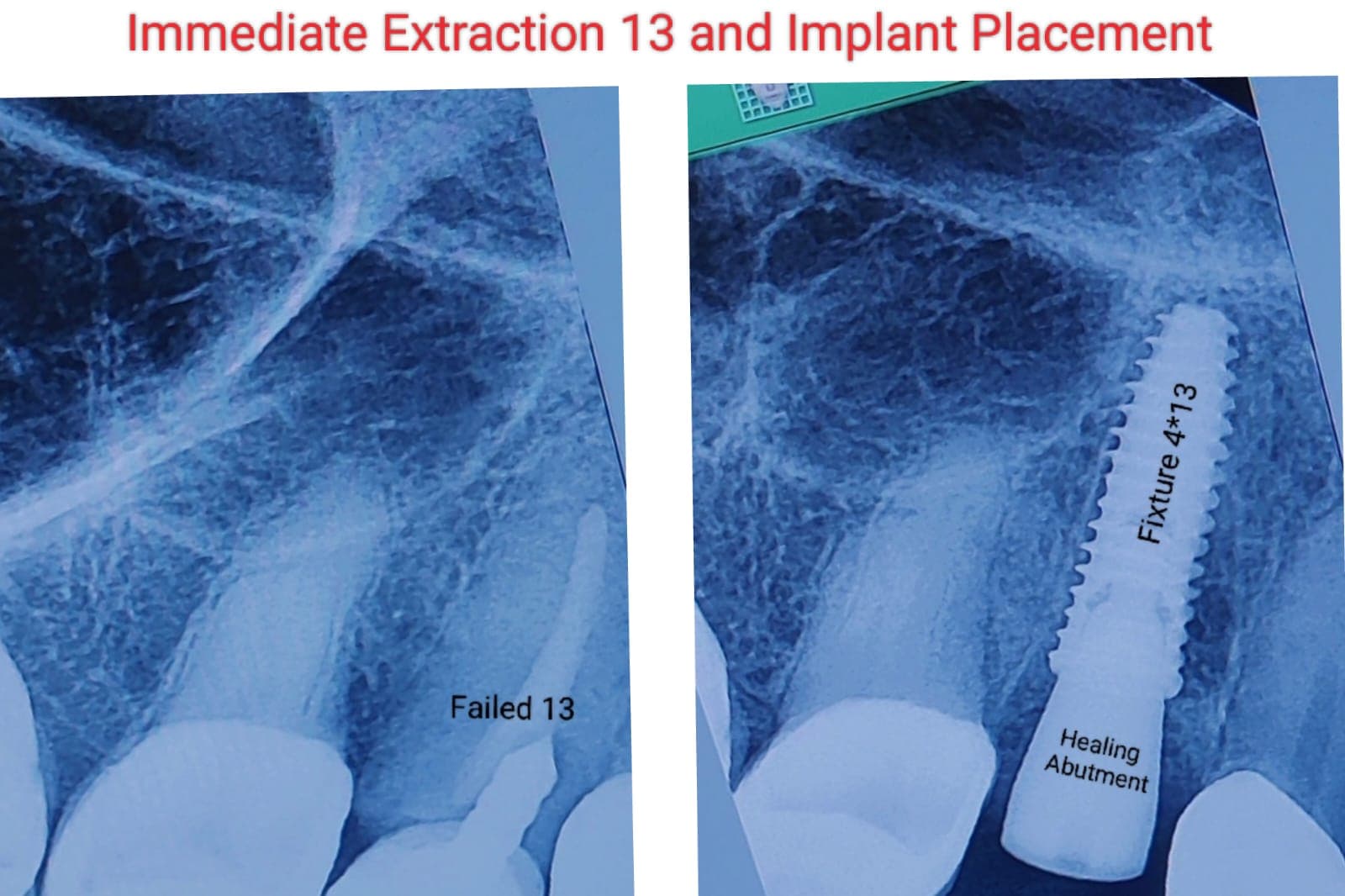Implant Case #10