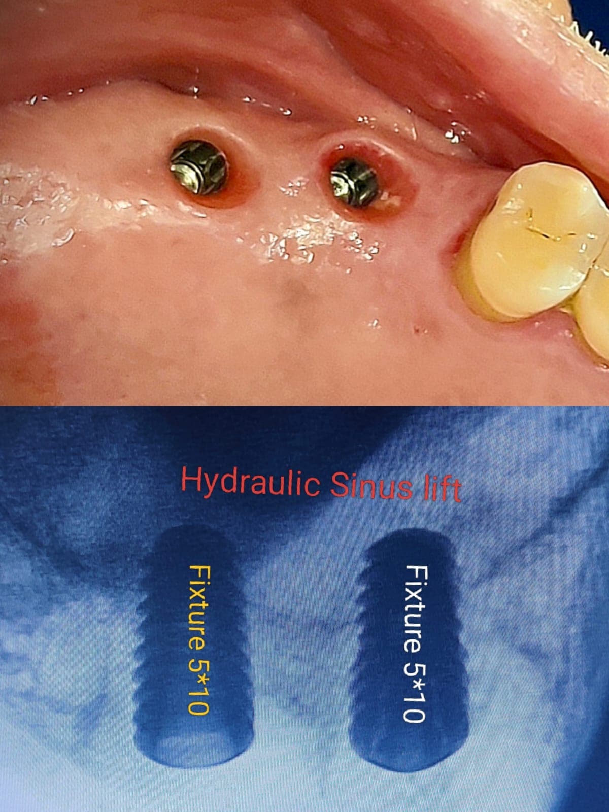 Implant Case #12