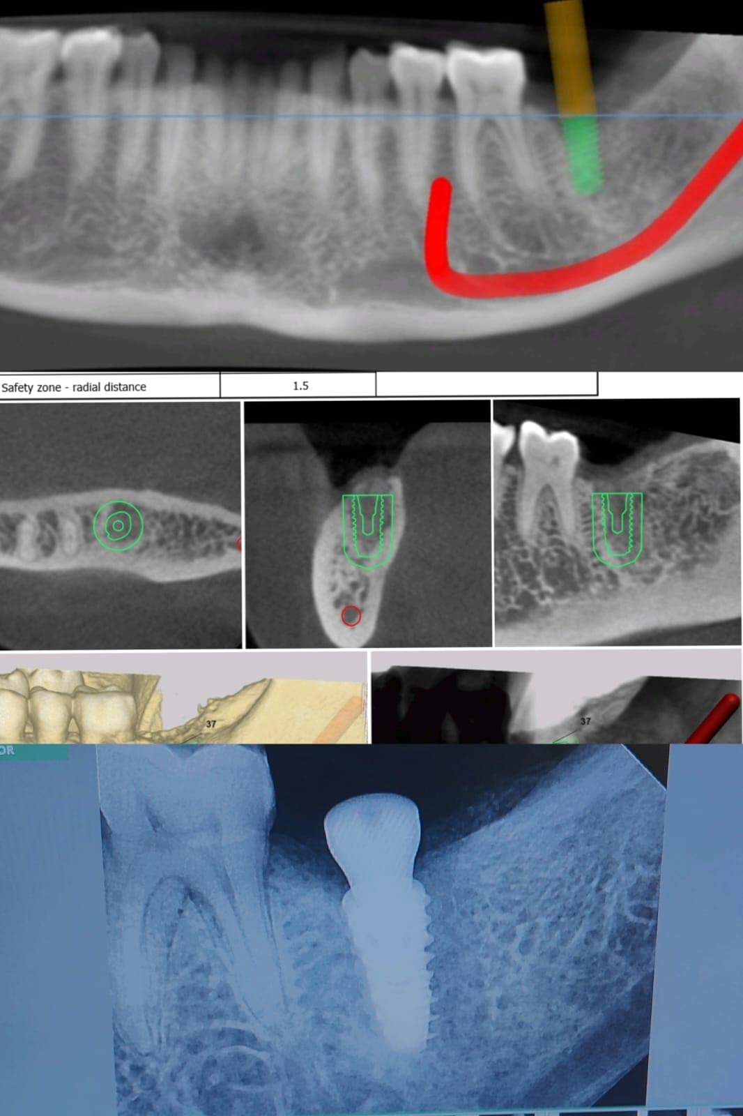 Implant Case #13