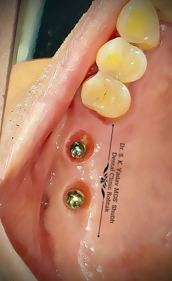 Implant Case #15