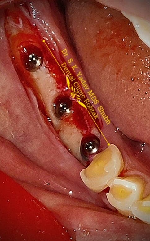 Implant Case #16