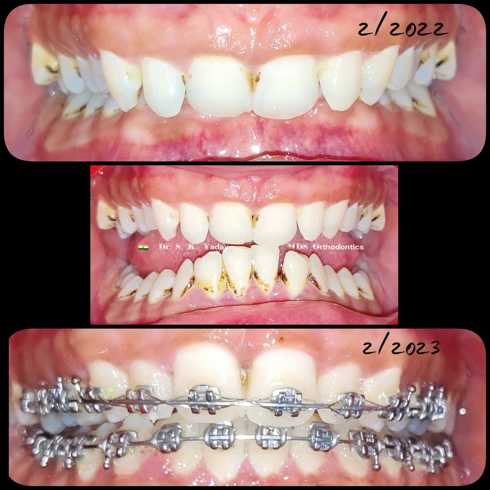 Orthodontic Case #1
