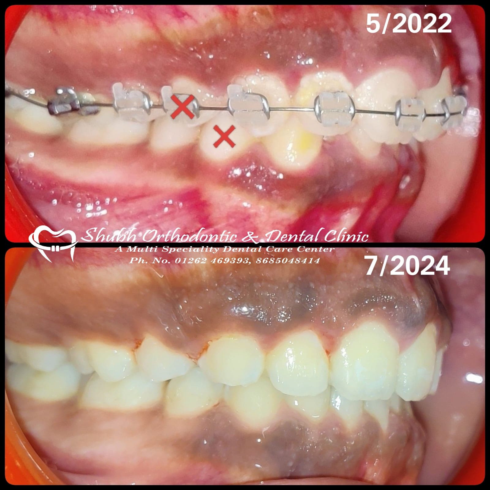 Orthodontic Case #4