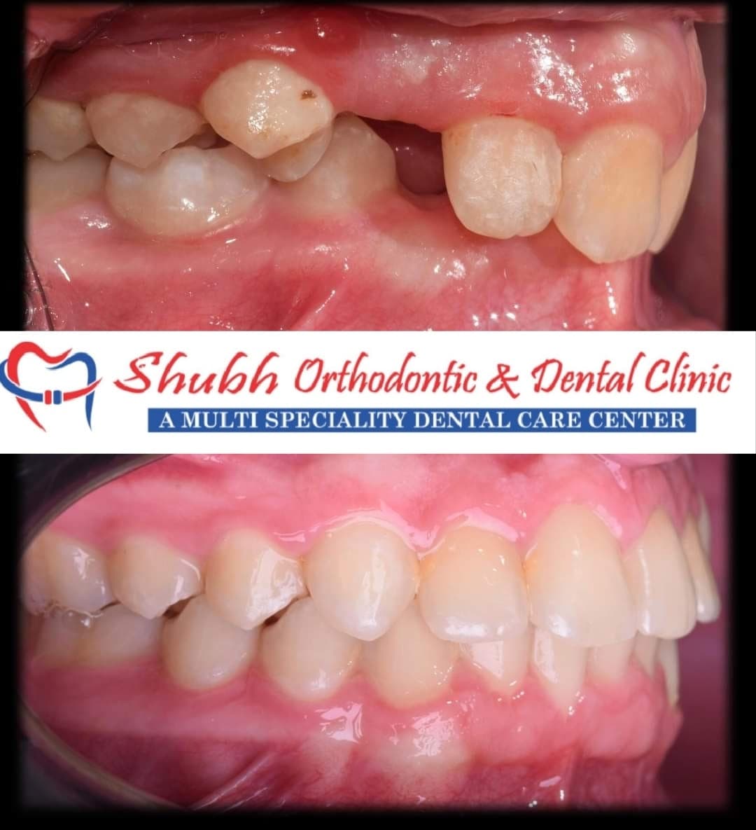 Orthodontic Case #5