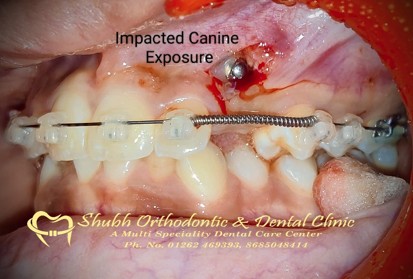 Orthodontic Case #6