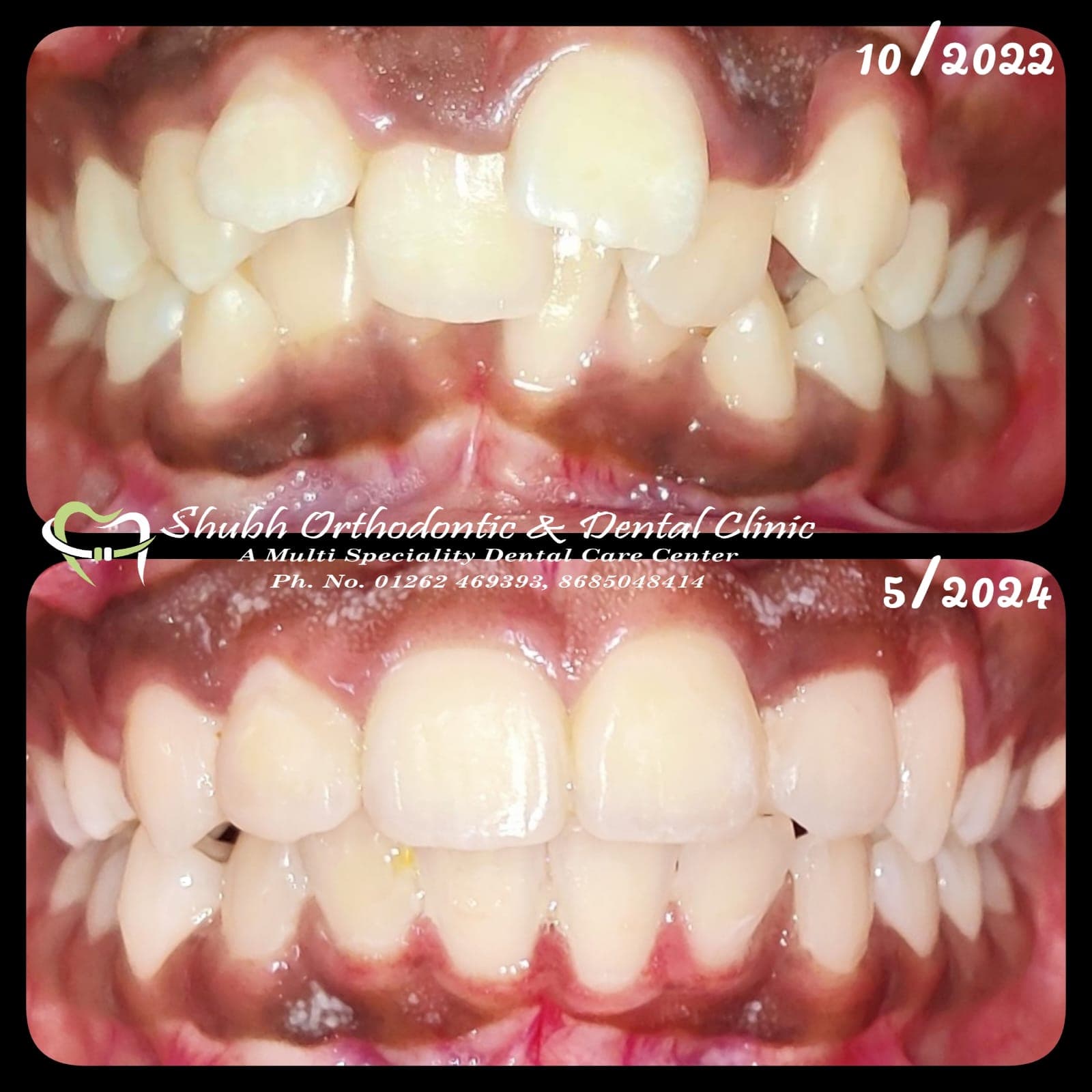 Orthodontic Case #9
