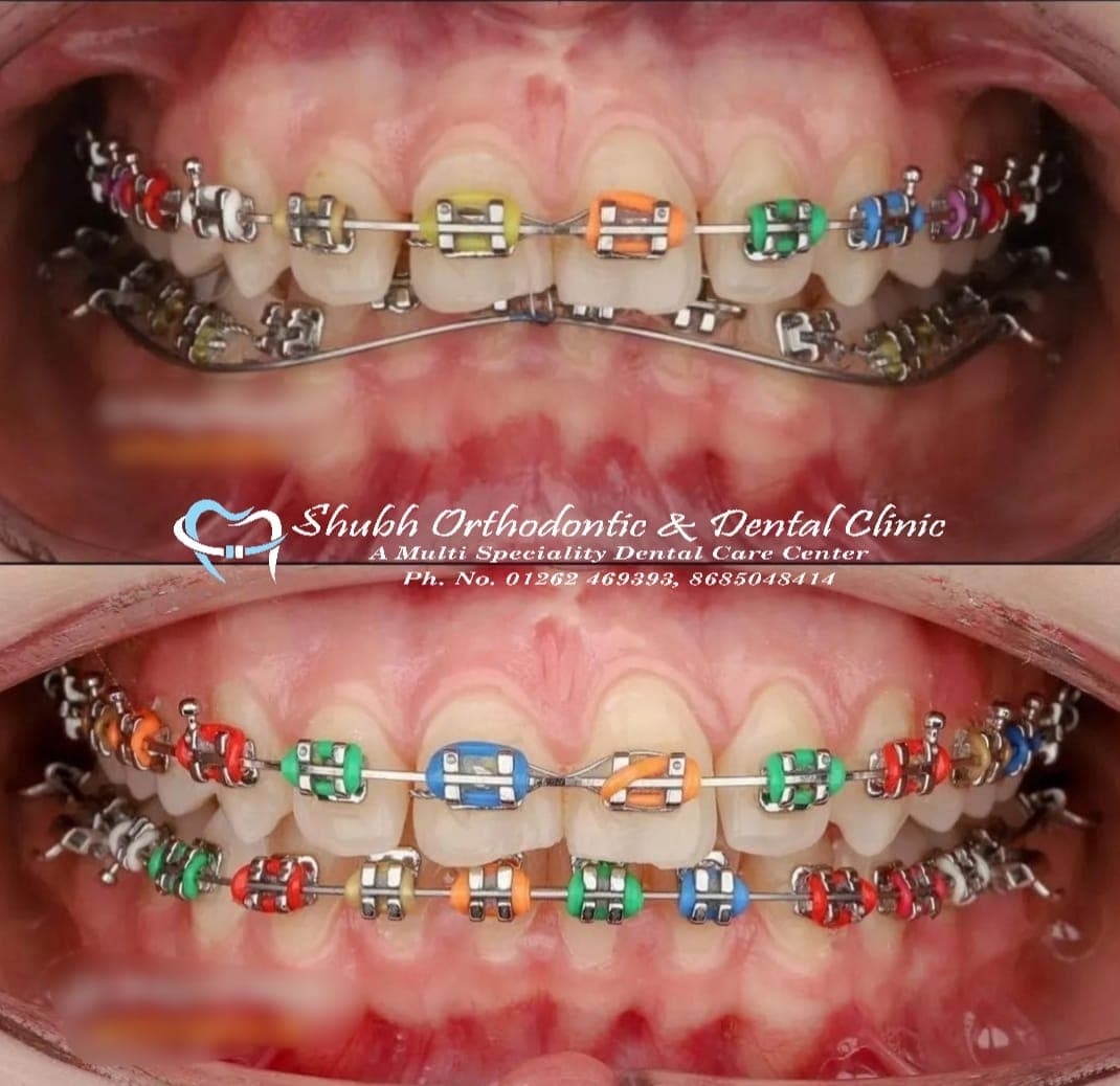 Orthodontic Case #10