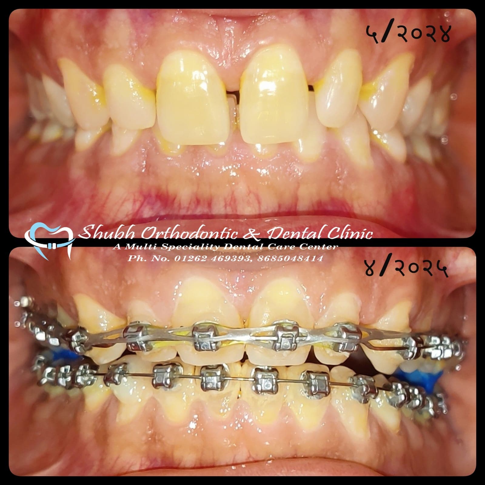 Orthodontic Case #13