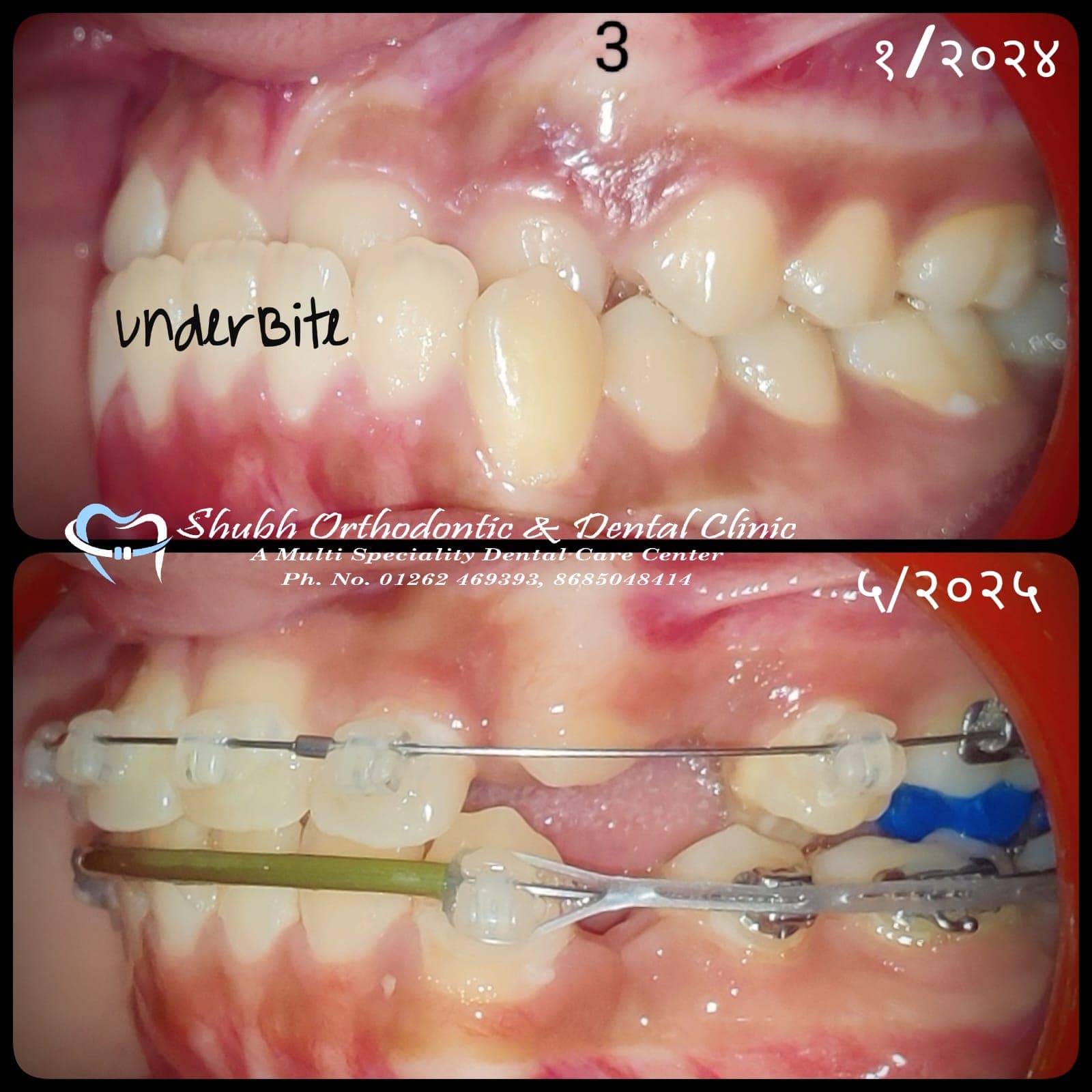 Orthodontic Case #15