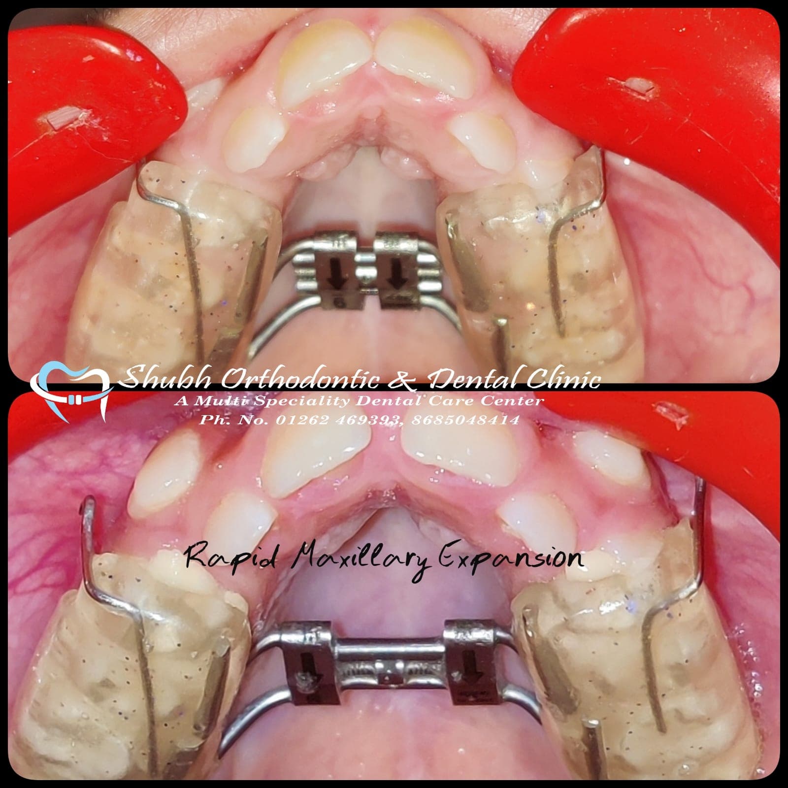 Orthodontic Case #17