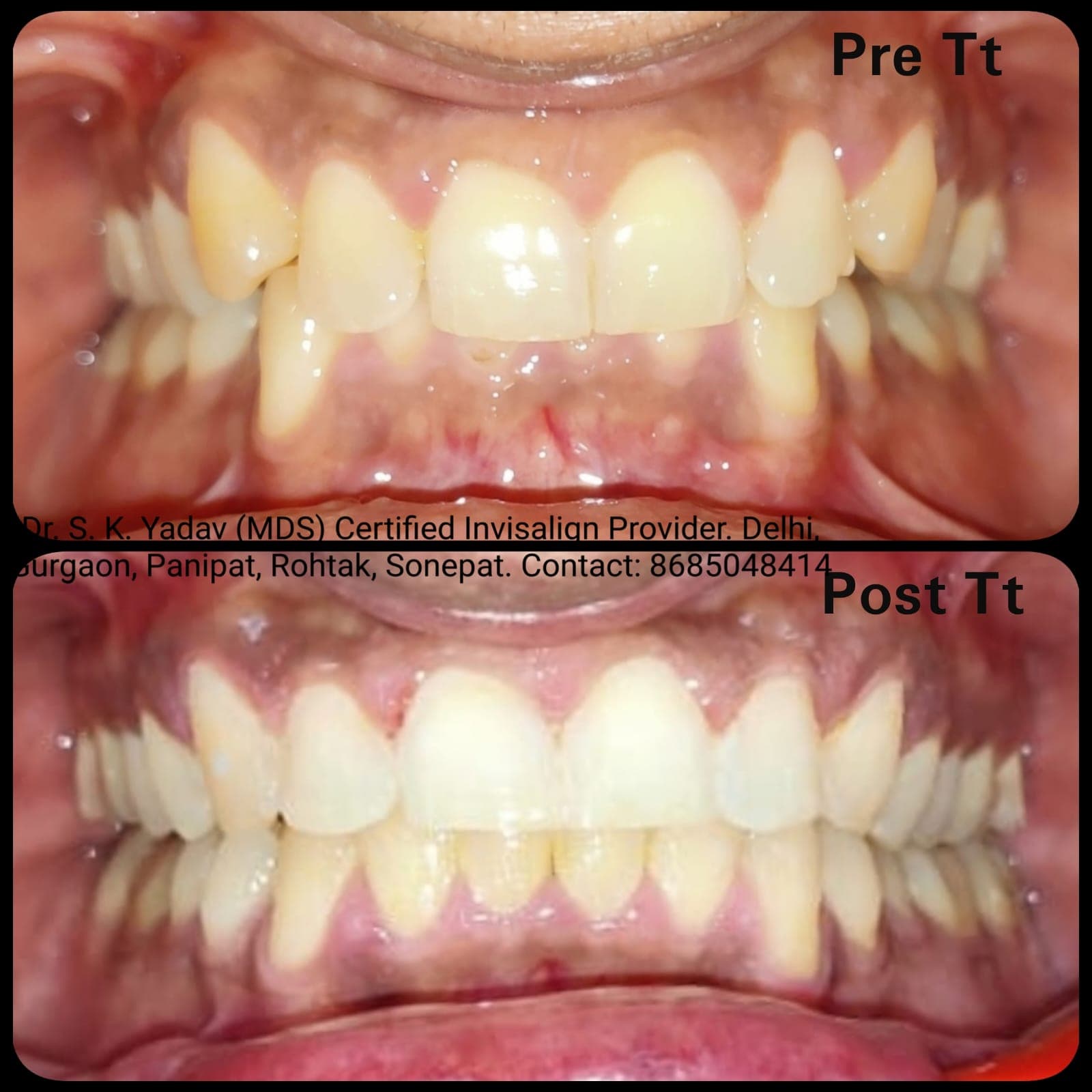 Orthodontic Case #19