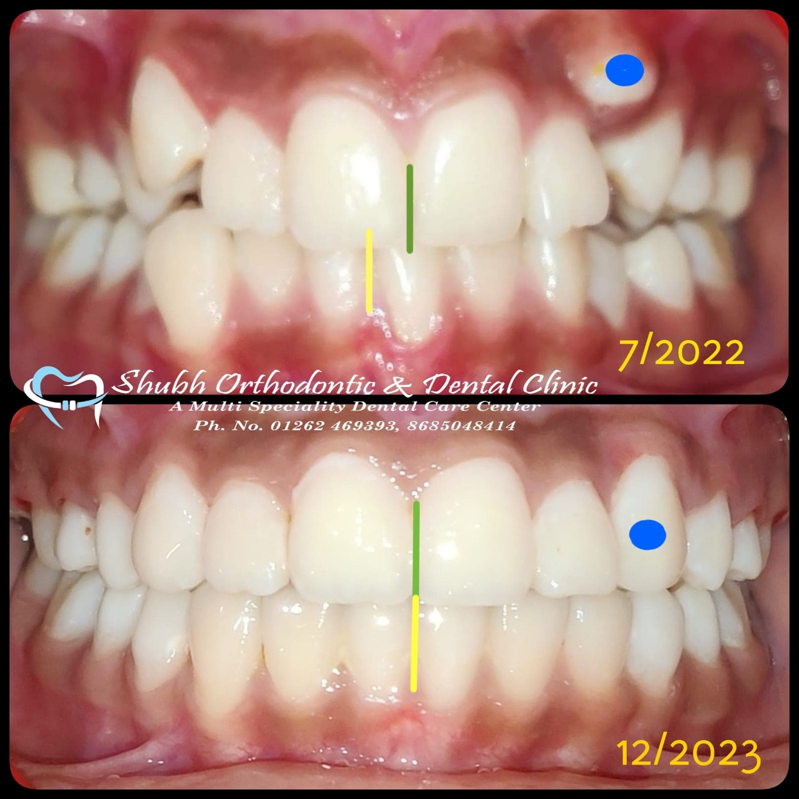 Orthodontic Case #20