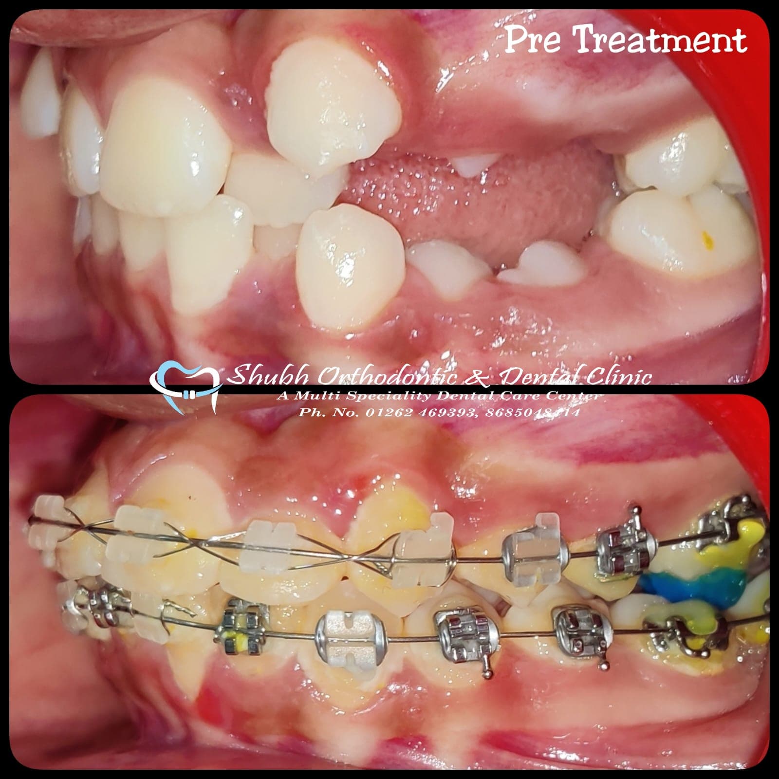 Orthodontic Case #21