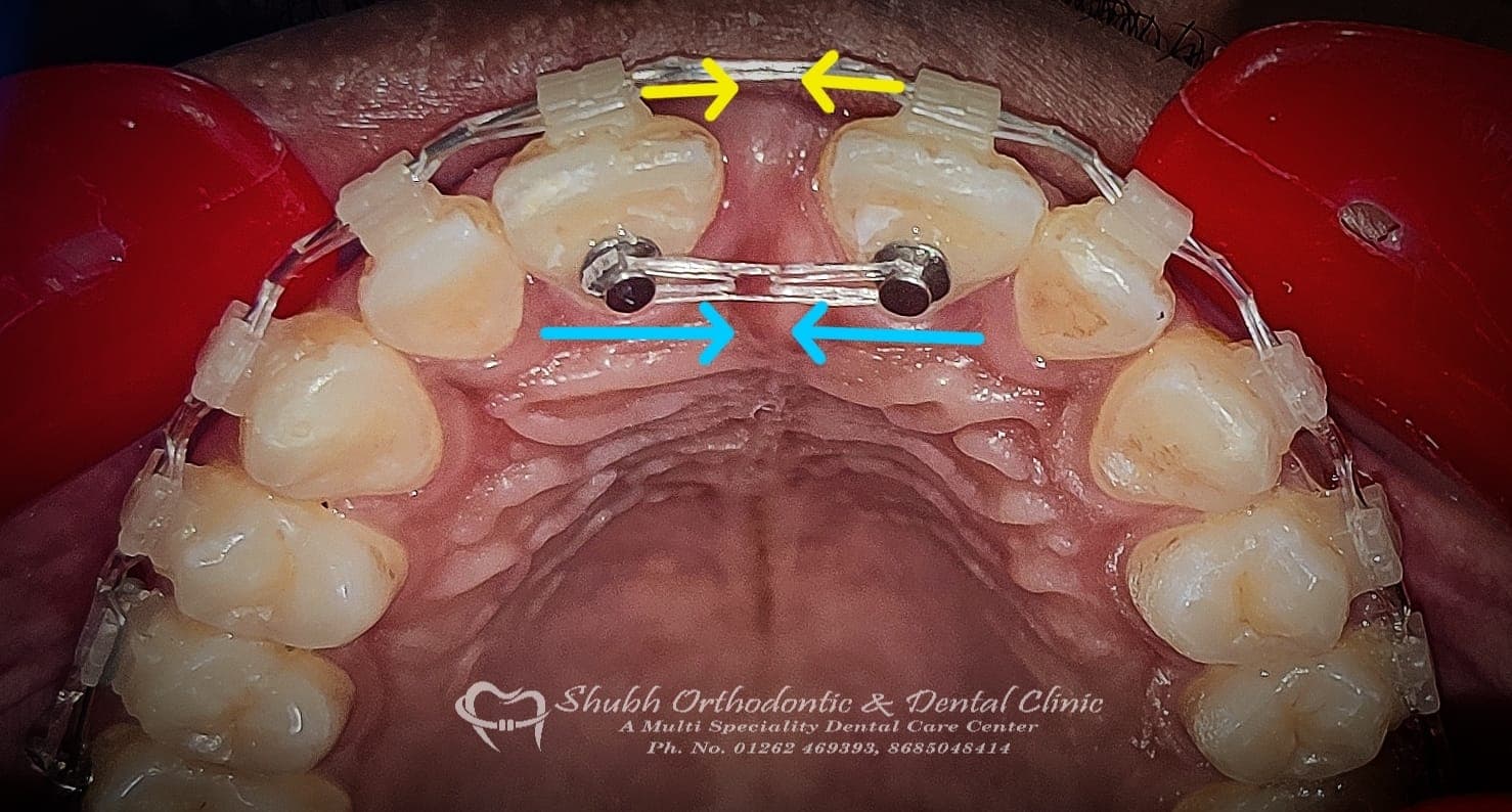 Orthodontic Case #22