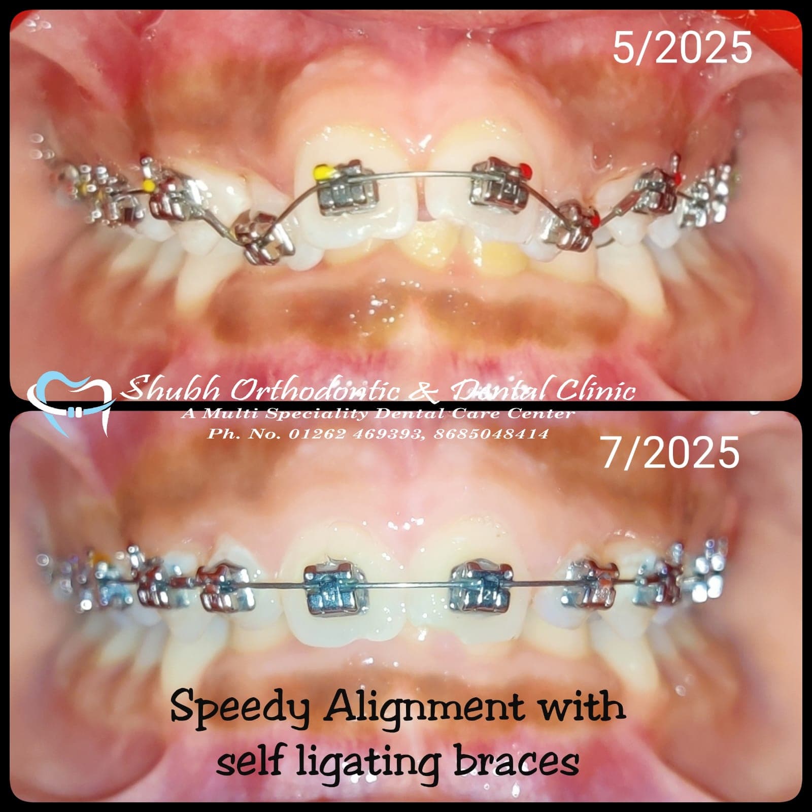 Orthodontic Case #24