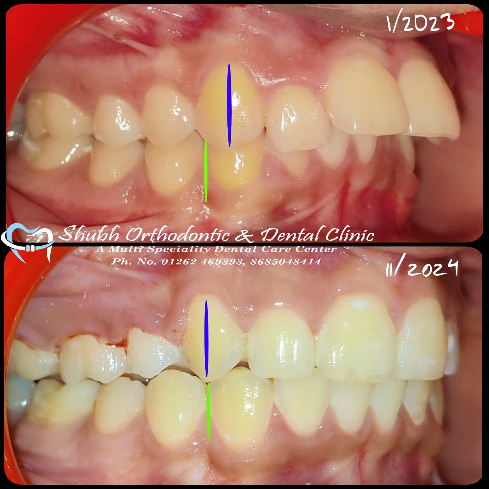 Orthodontic Case #25