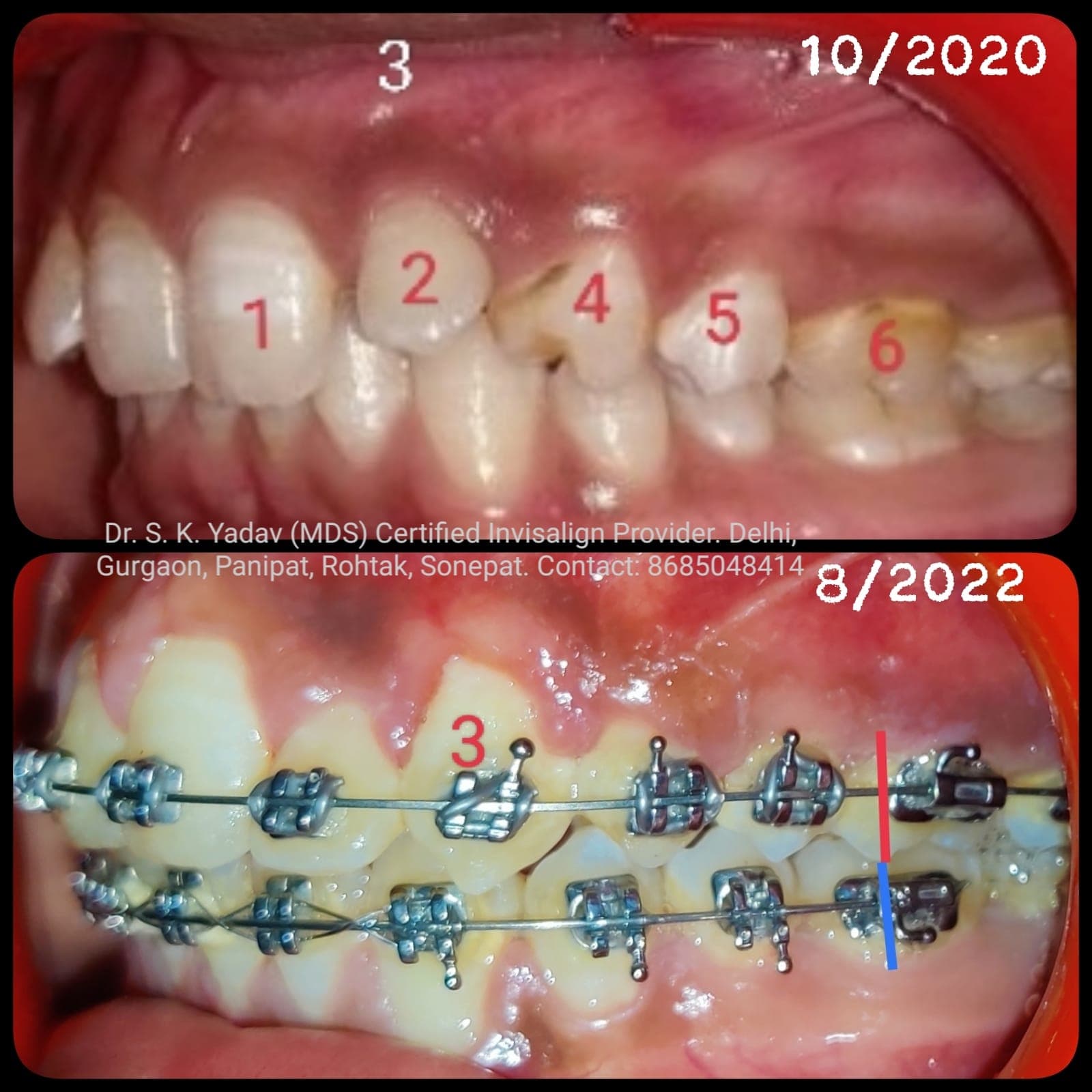 Orthodontic Case #26