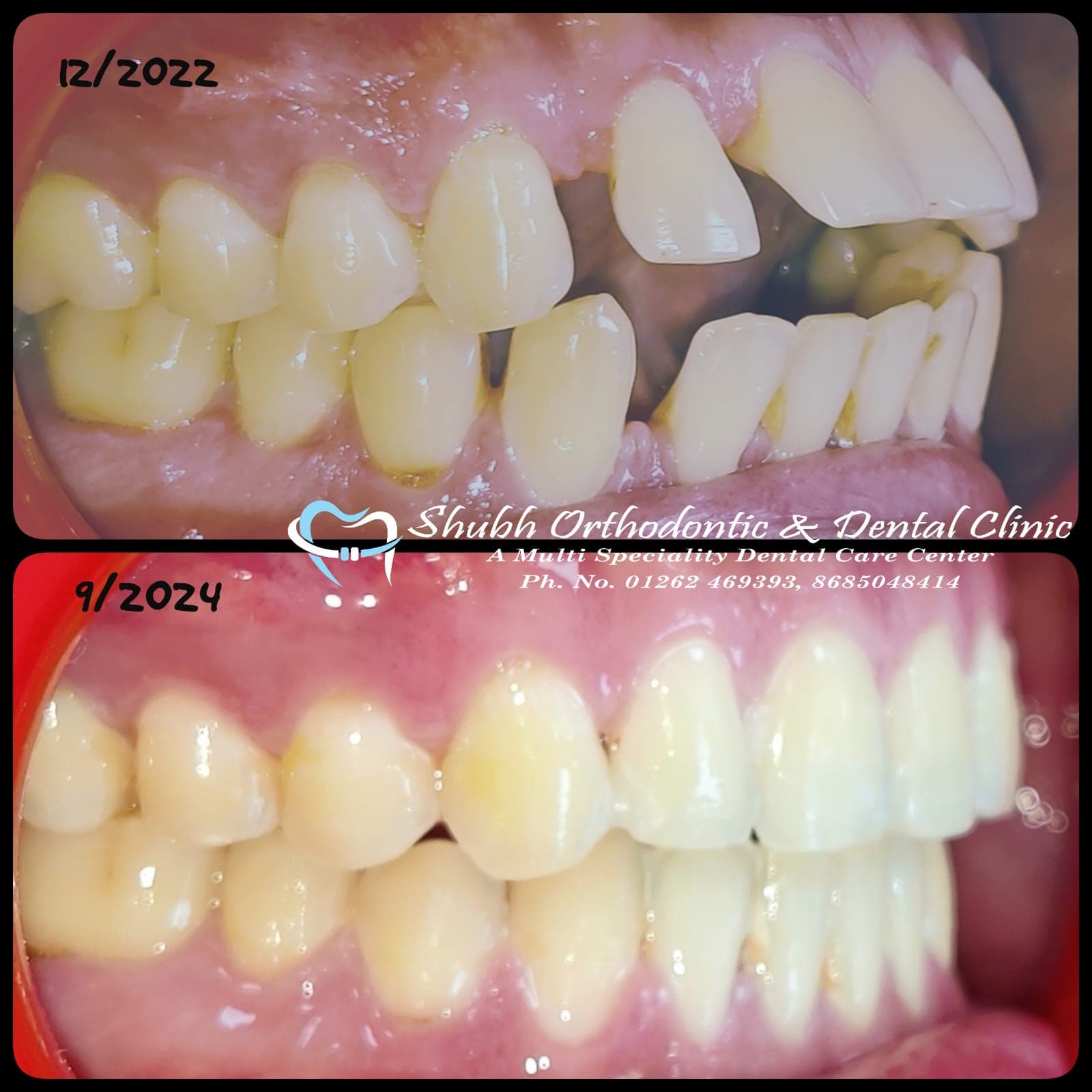 Orthodontic Case #27