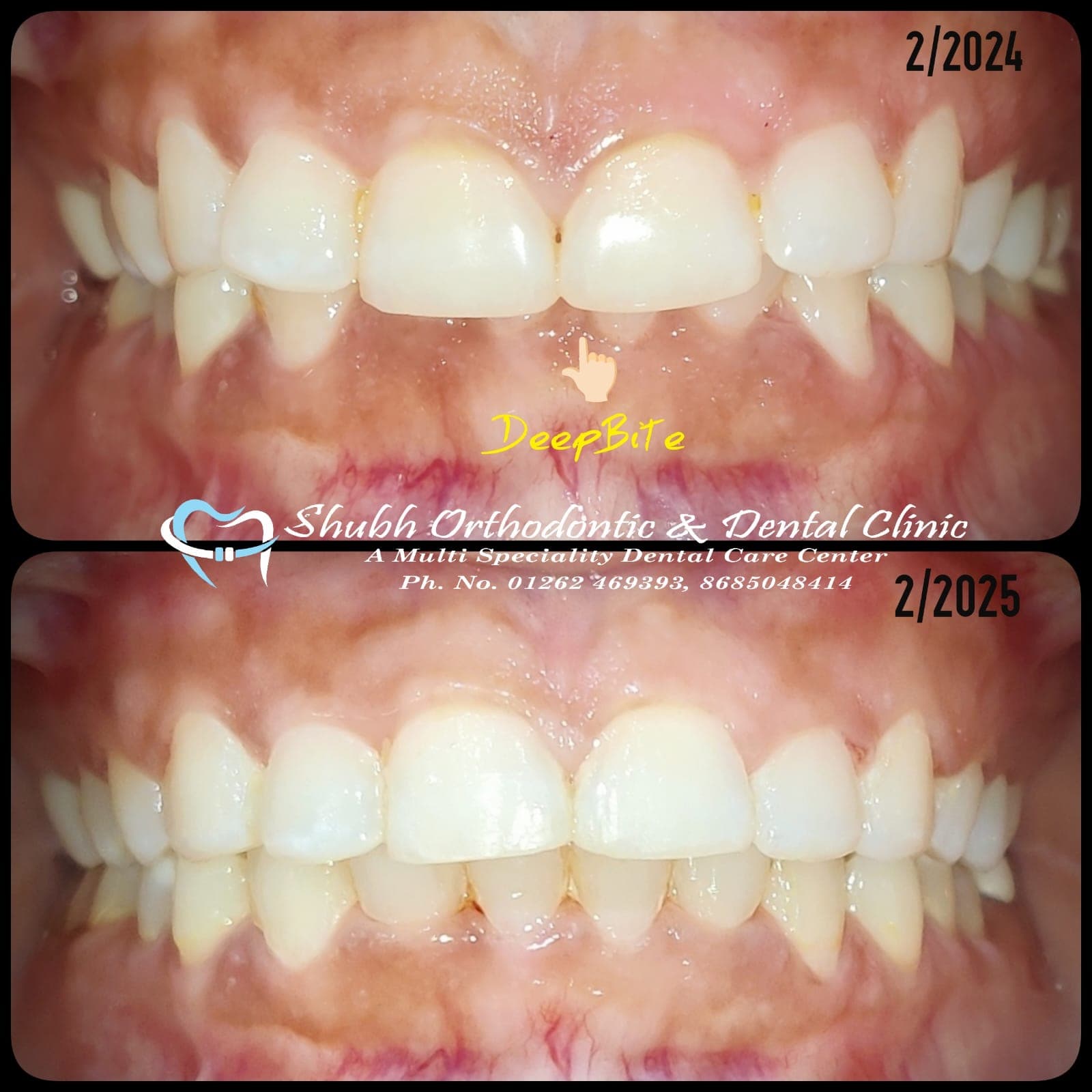 Orthodontic Case #28