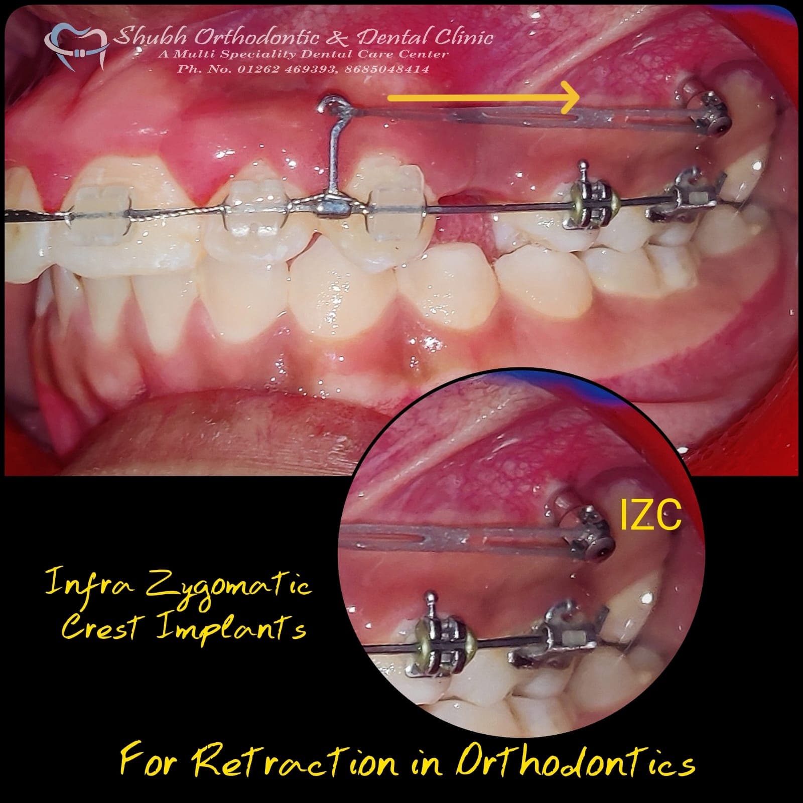 Orthodontic Case #29