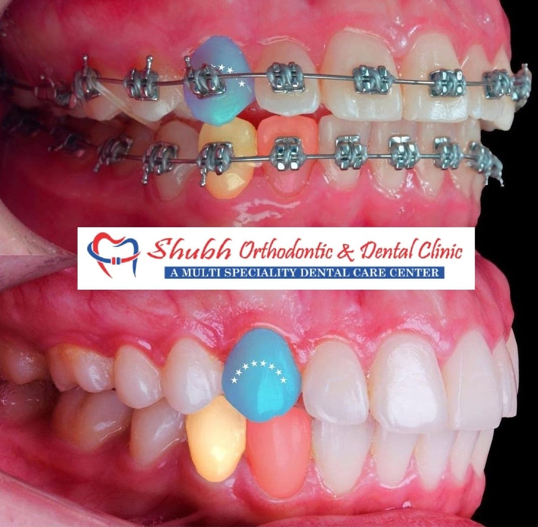 Orthodontic Case #30