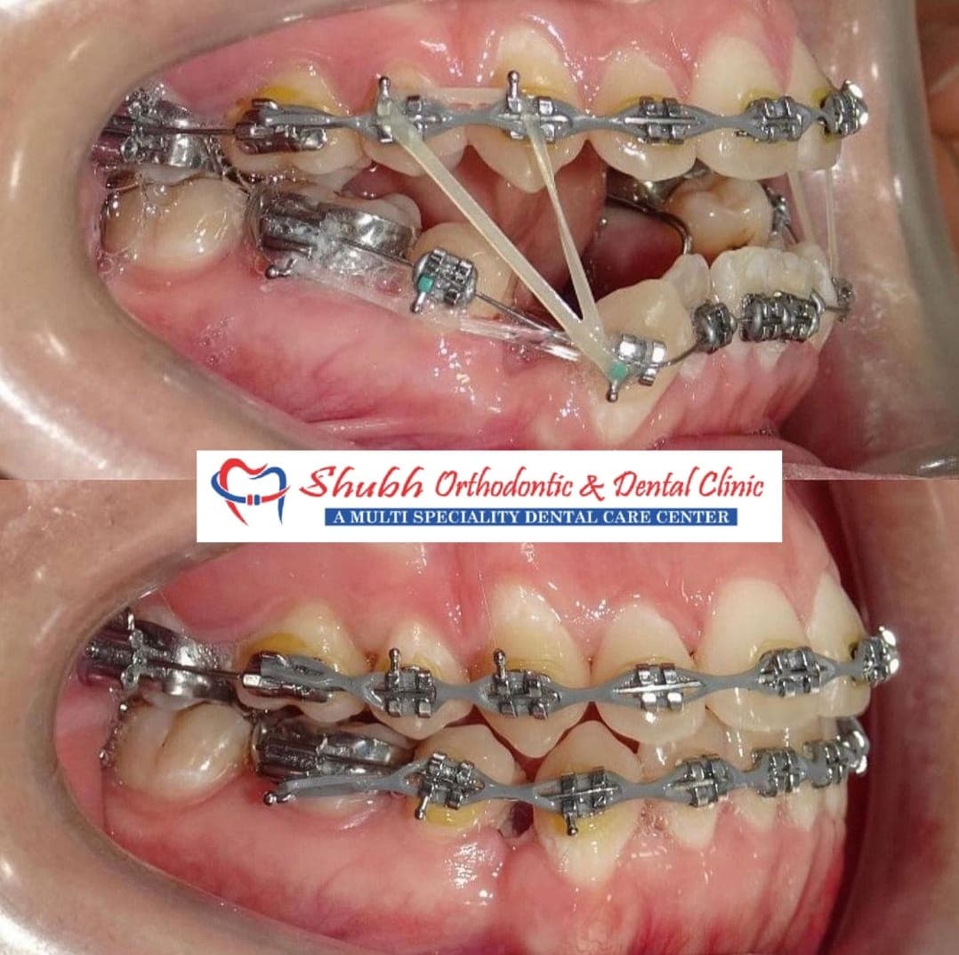 Orthodontic Case #31
