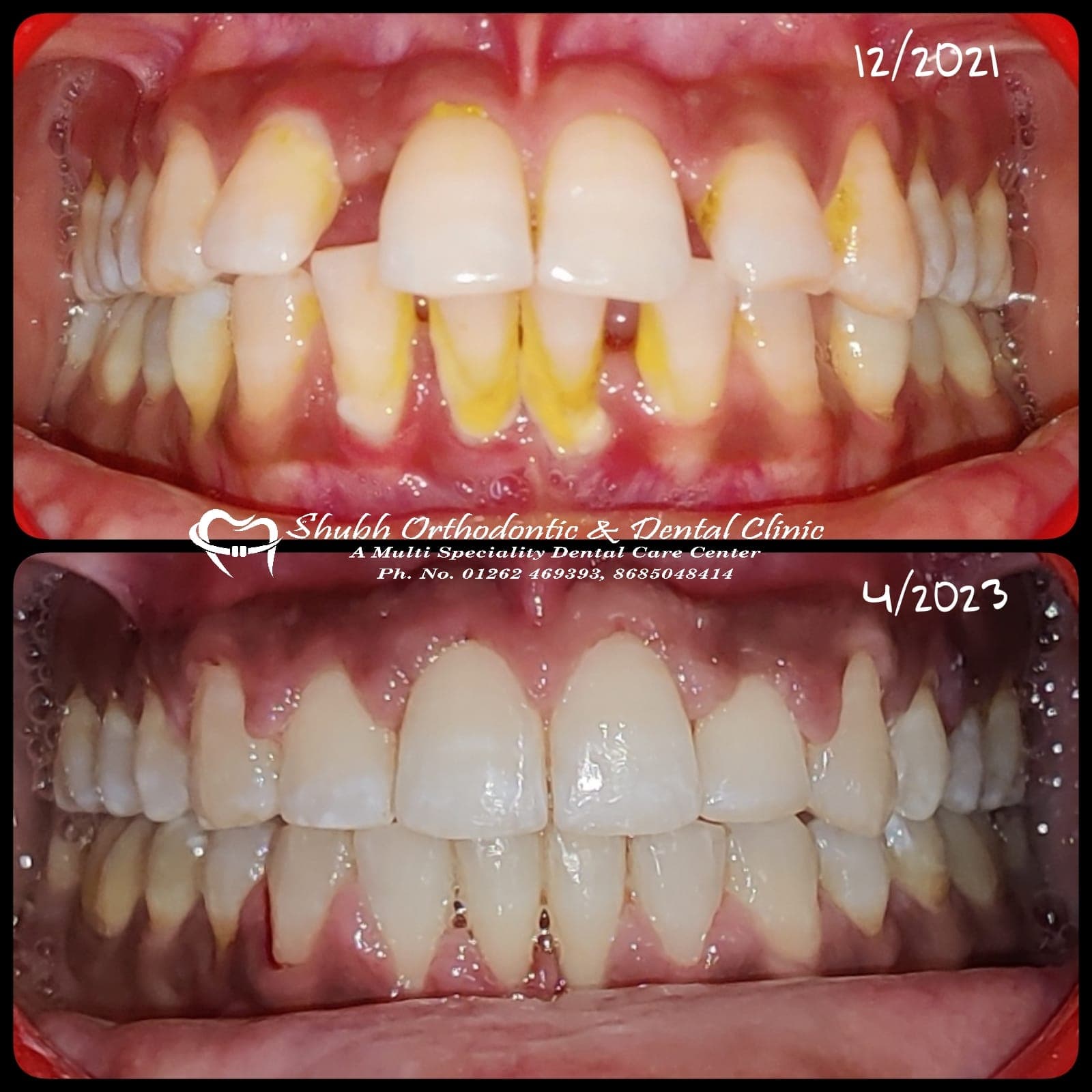 Orthodontic Case #32