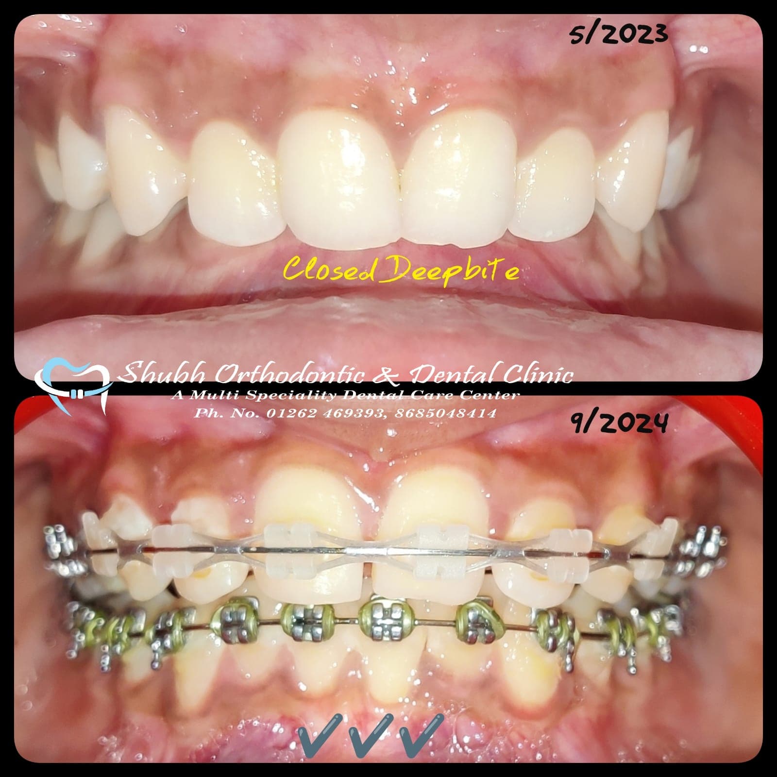 Orthodontic Case #33