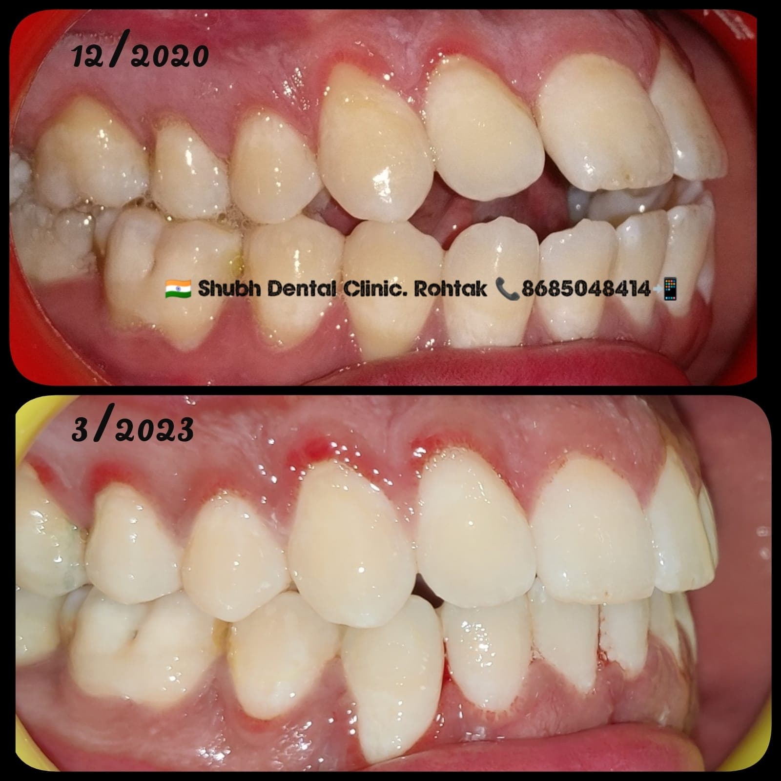Orthodontic Case #34