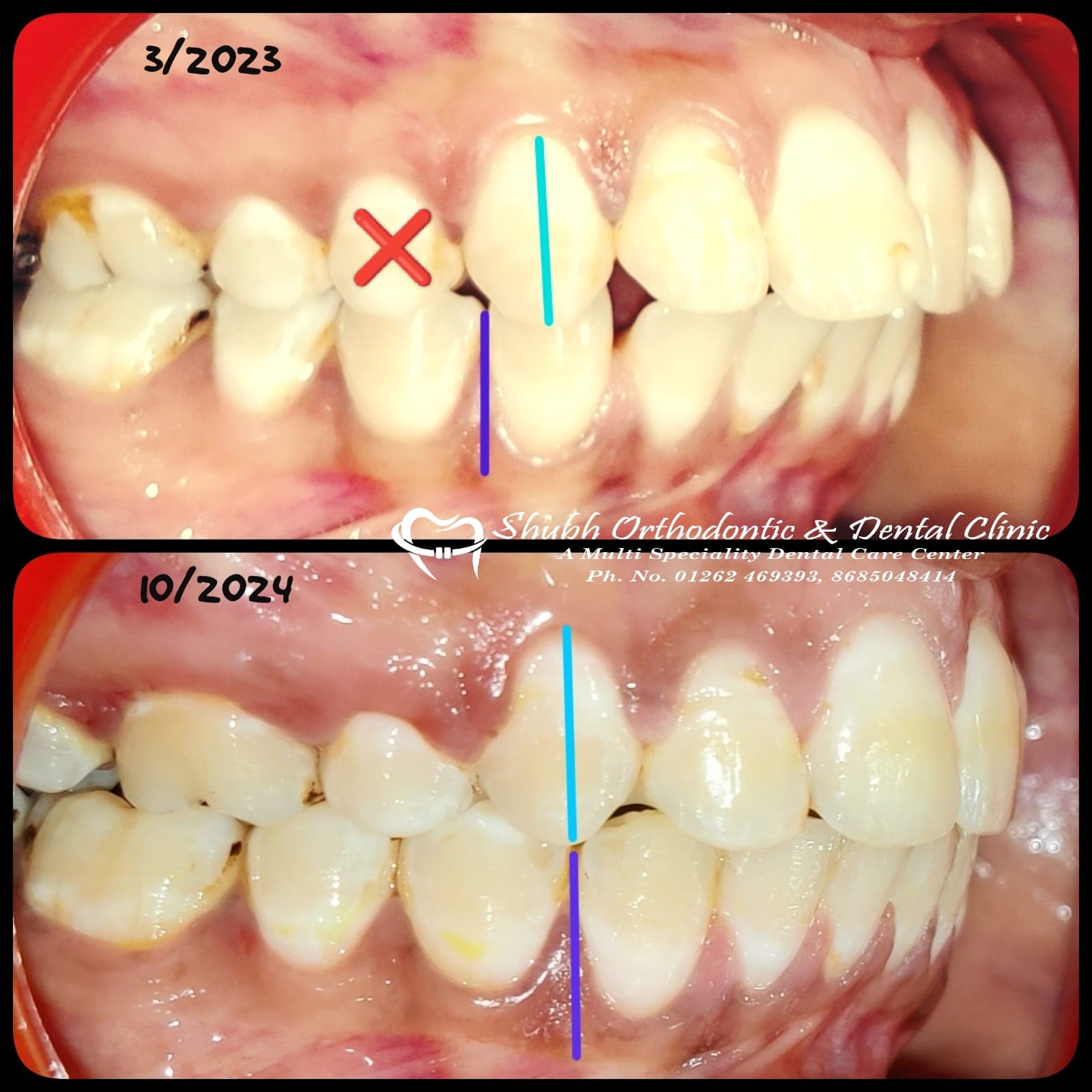 Orthodontic Case #37