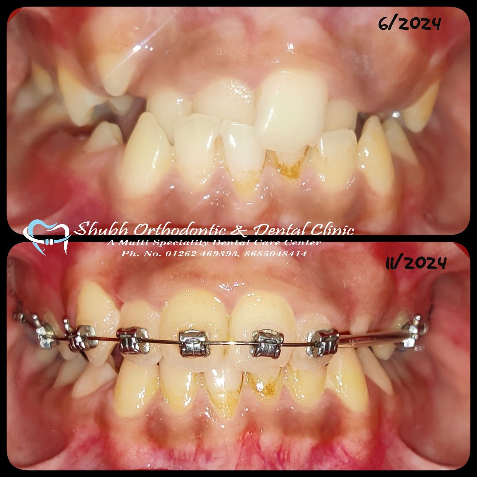 Orthodontic Case #38
