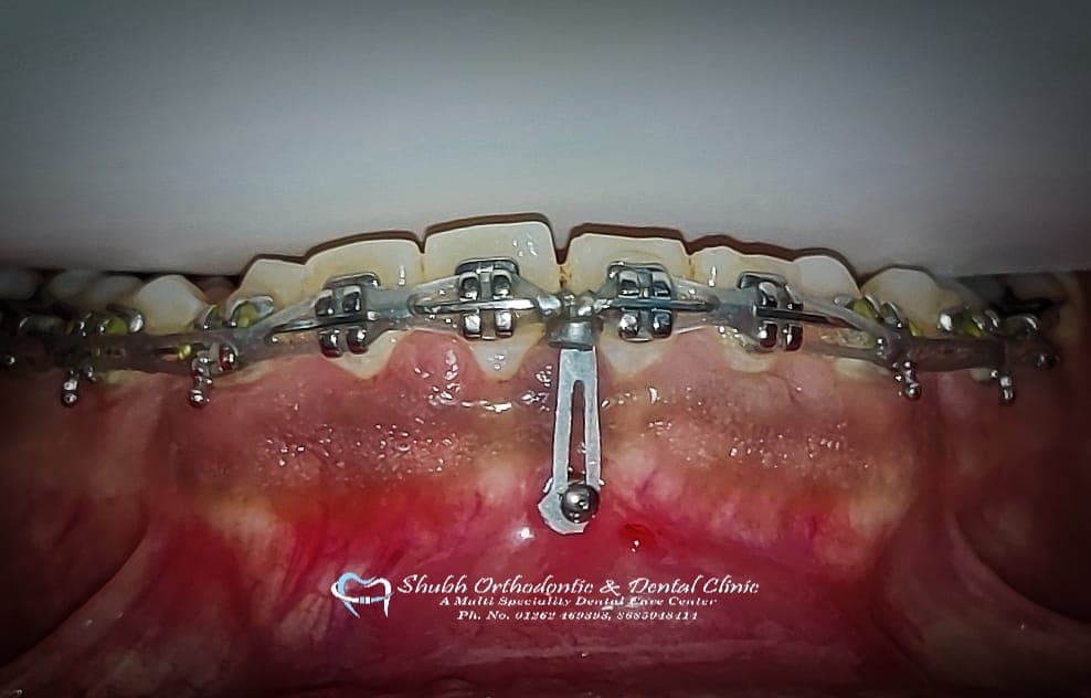 Orthodontic Case #39