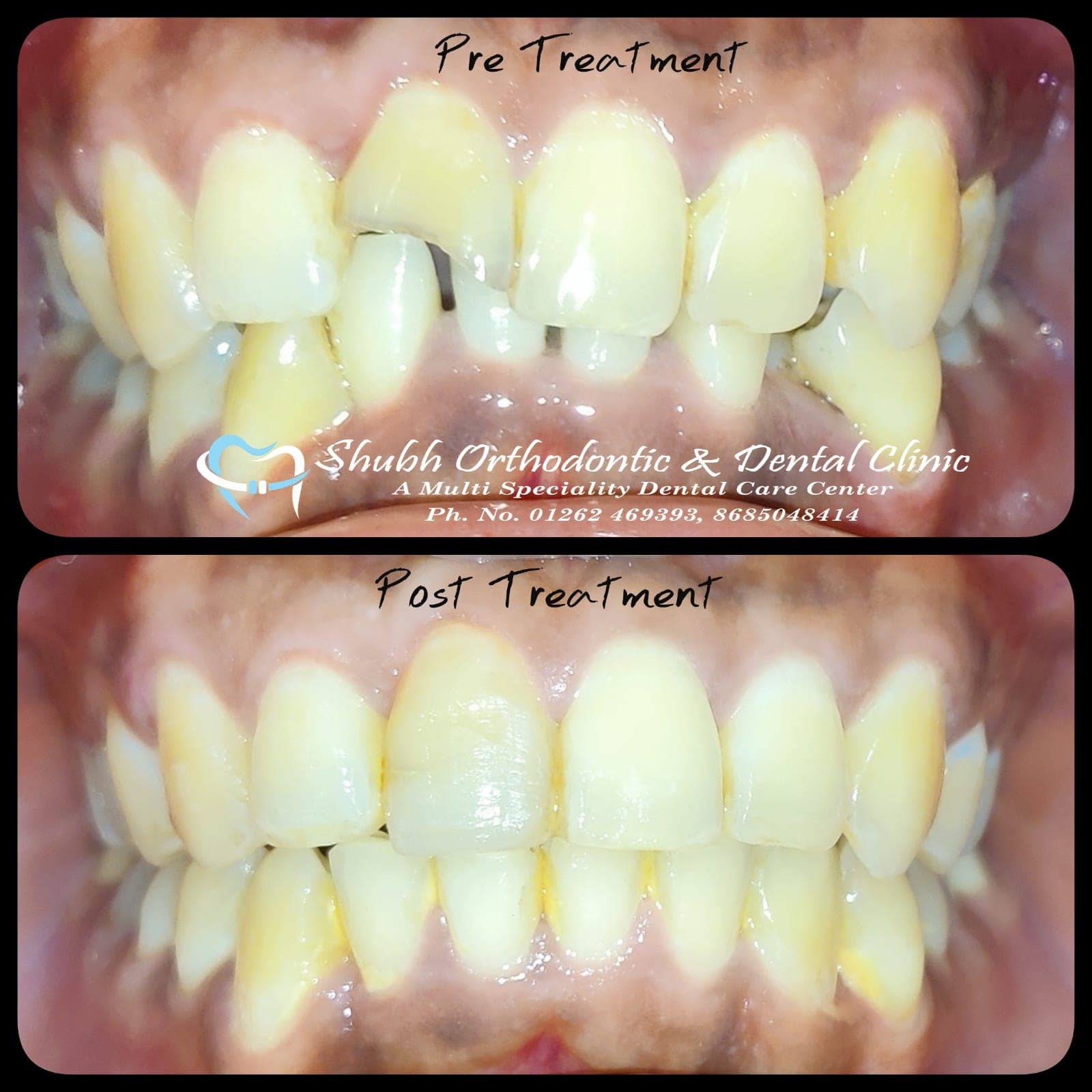 Orthodontic Case #40