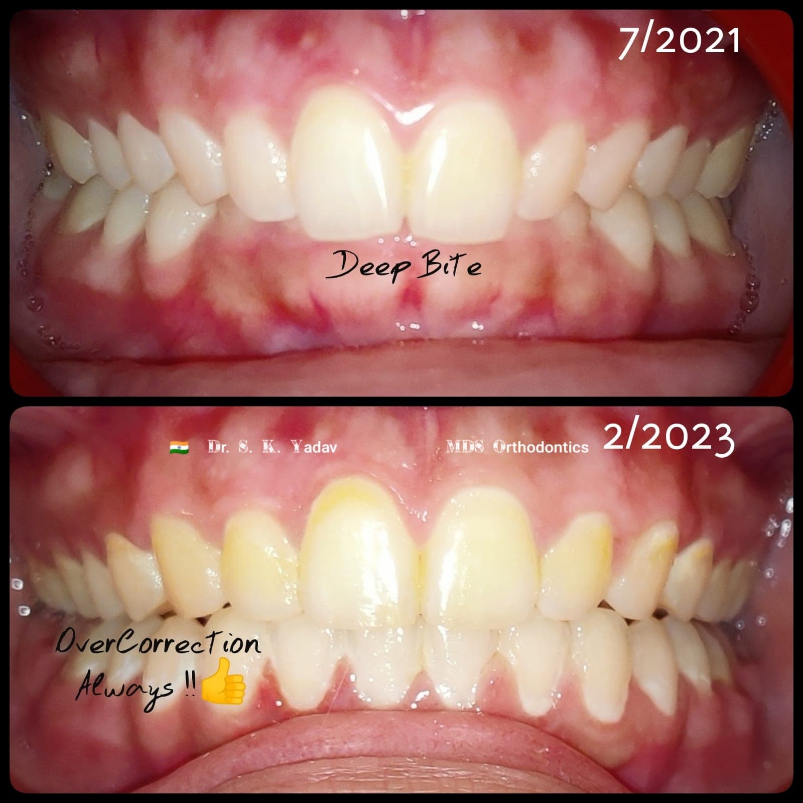 Orthodontic Case #41