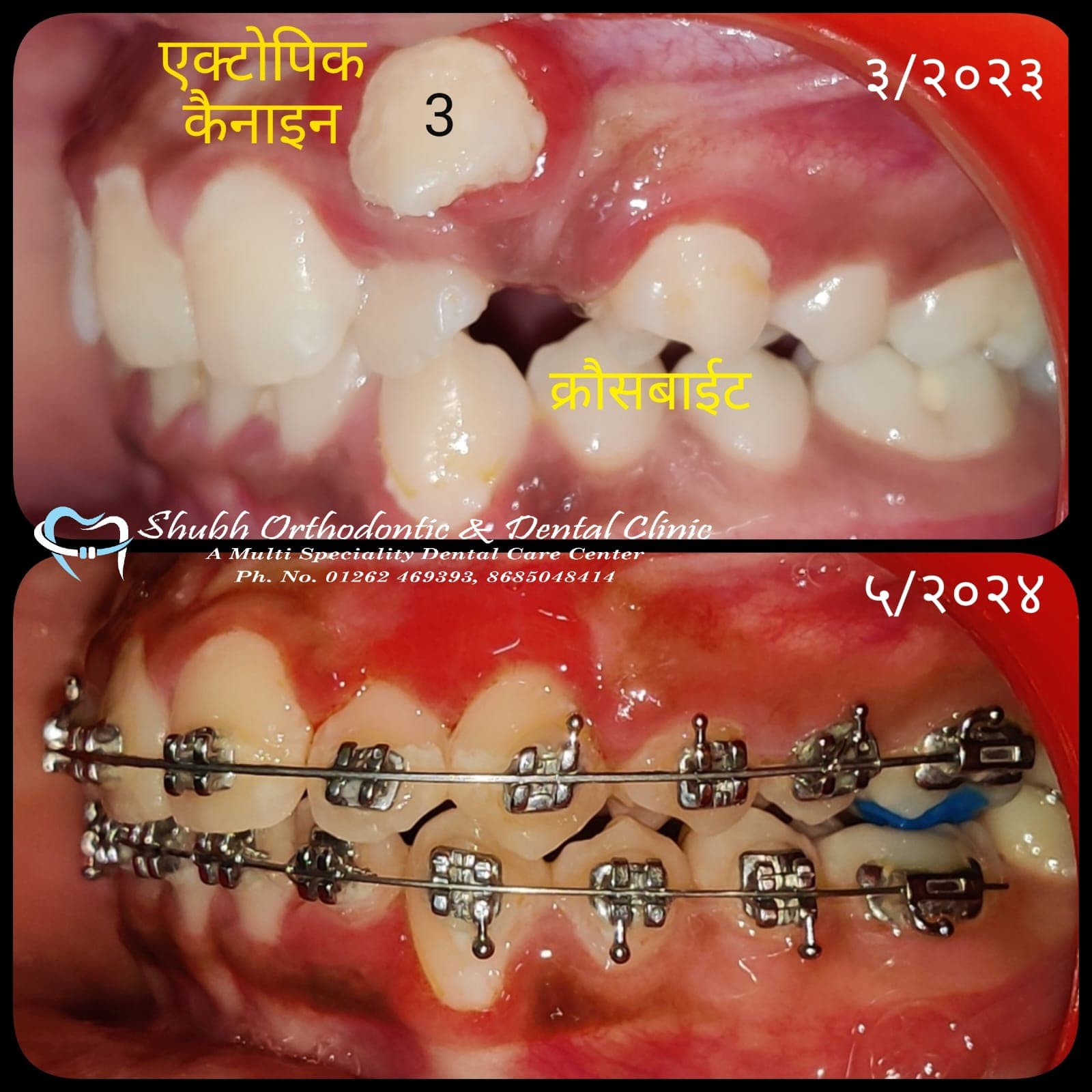 Orthodontic Case #42