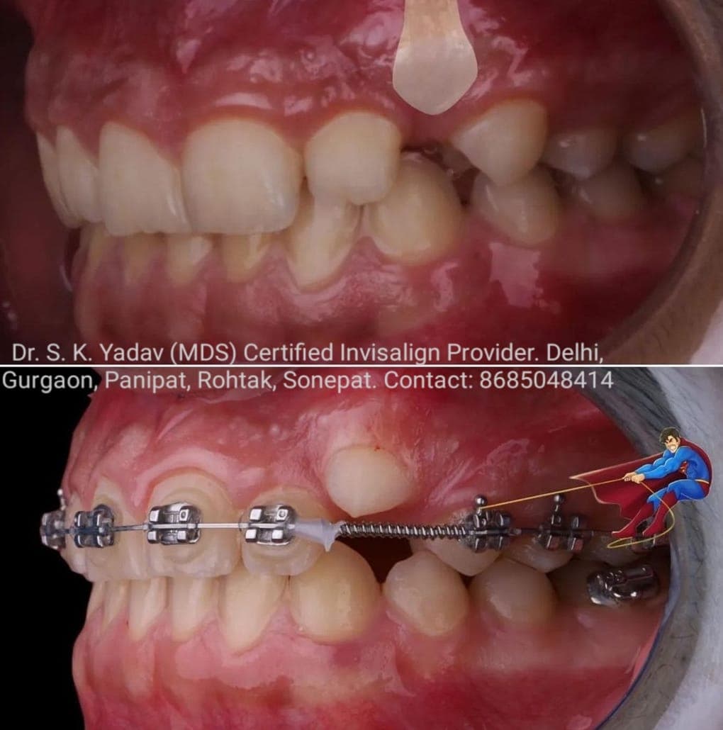 Orthodontic Case #43