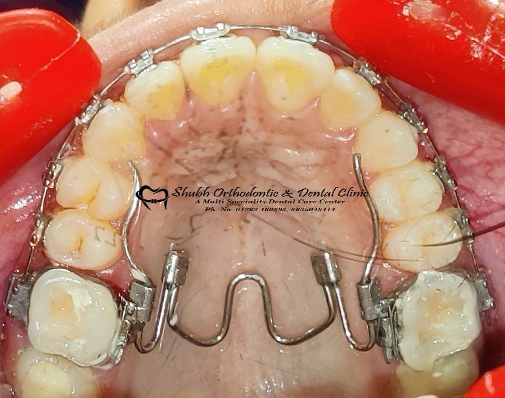 Orthodontic Case #44
