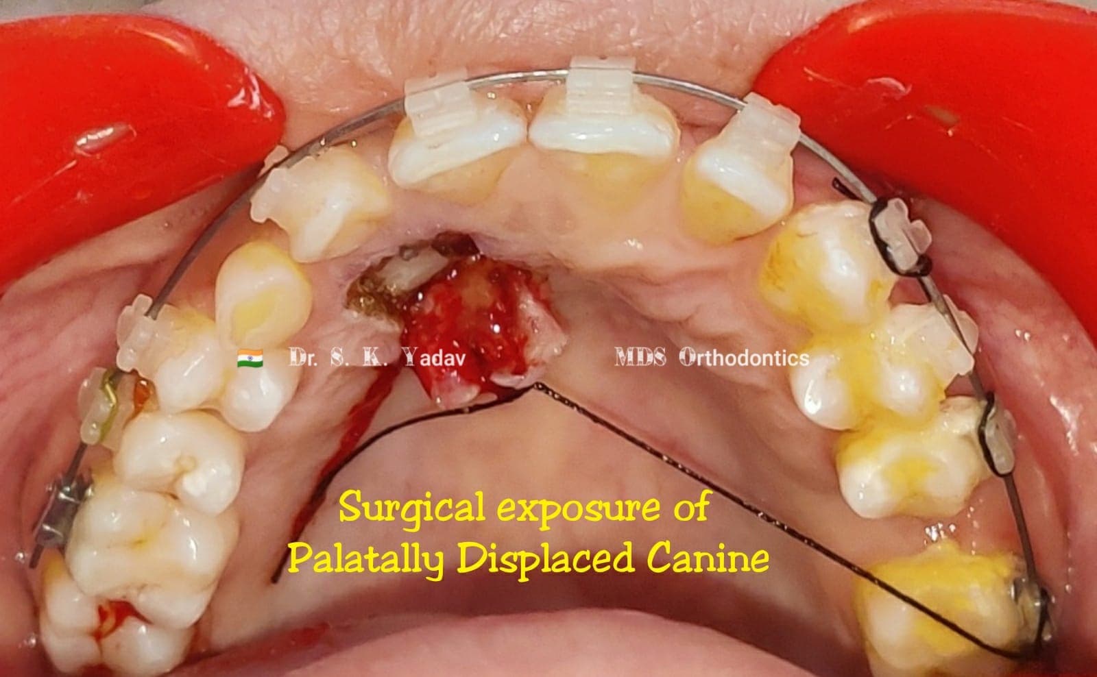 Orthodontic Case #45