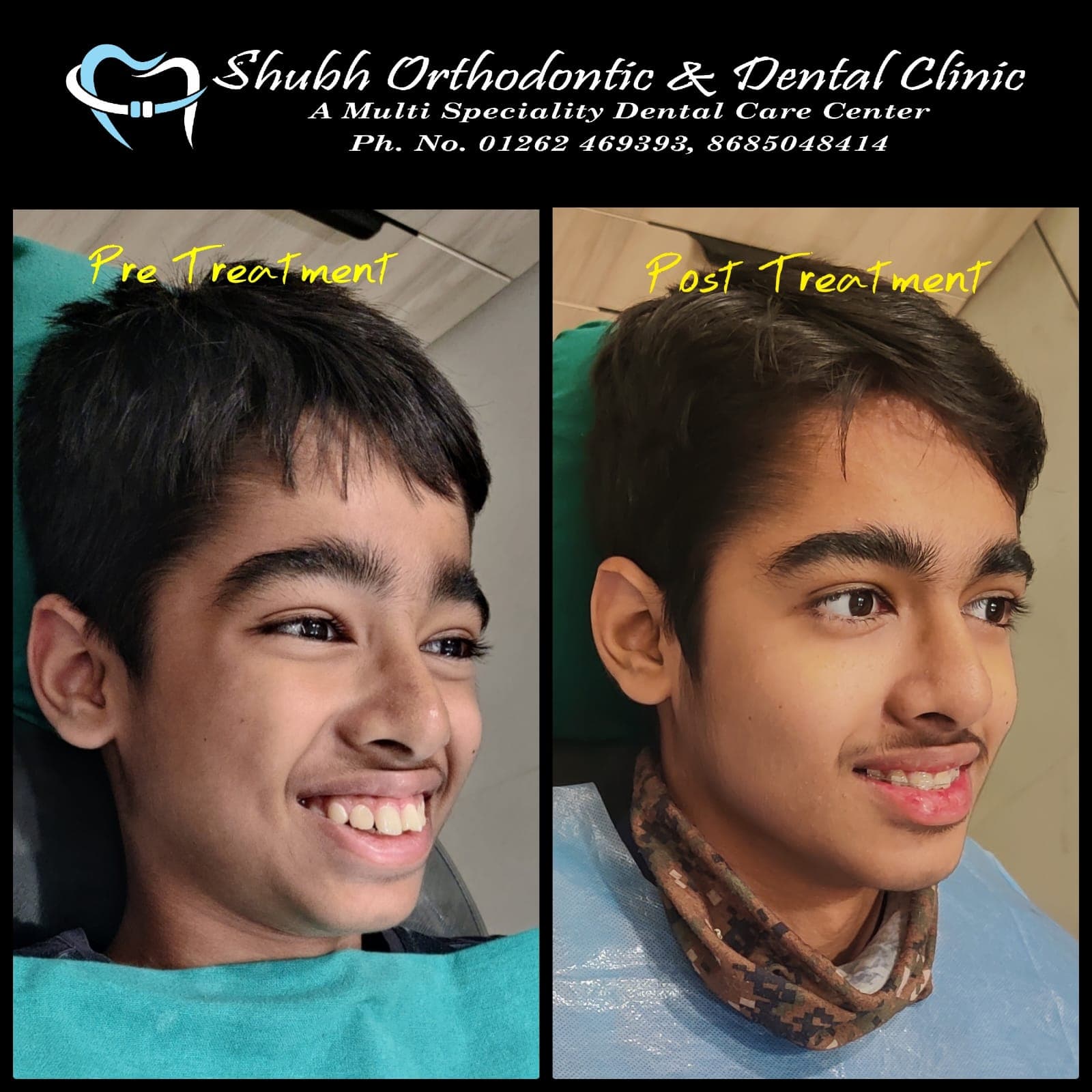 Smile Transformation #1
