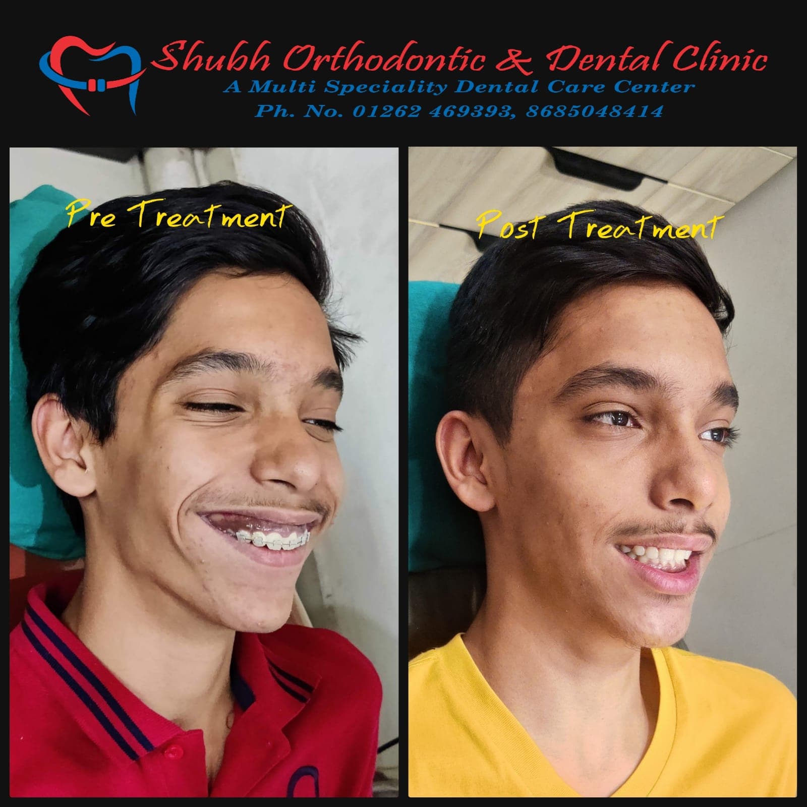 Smile Transformation #3