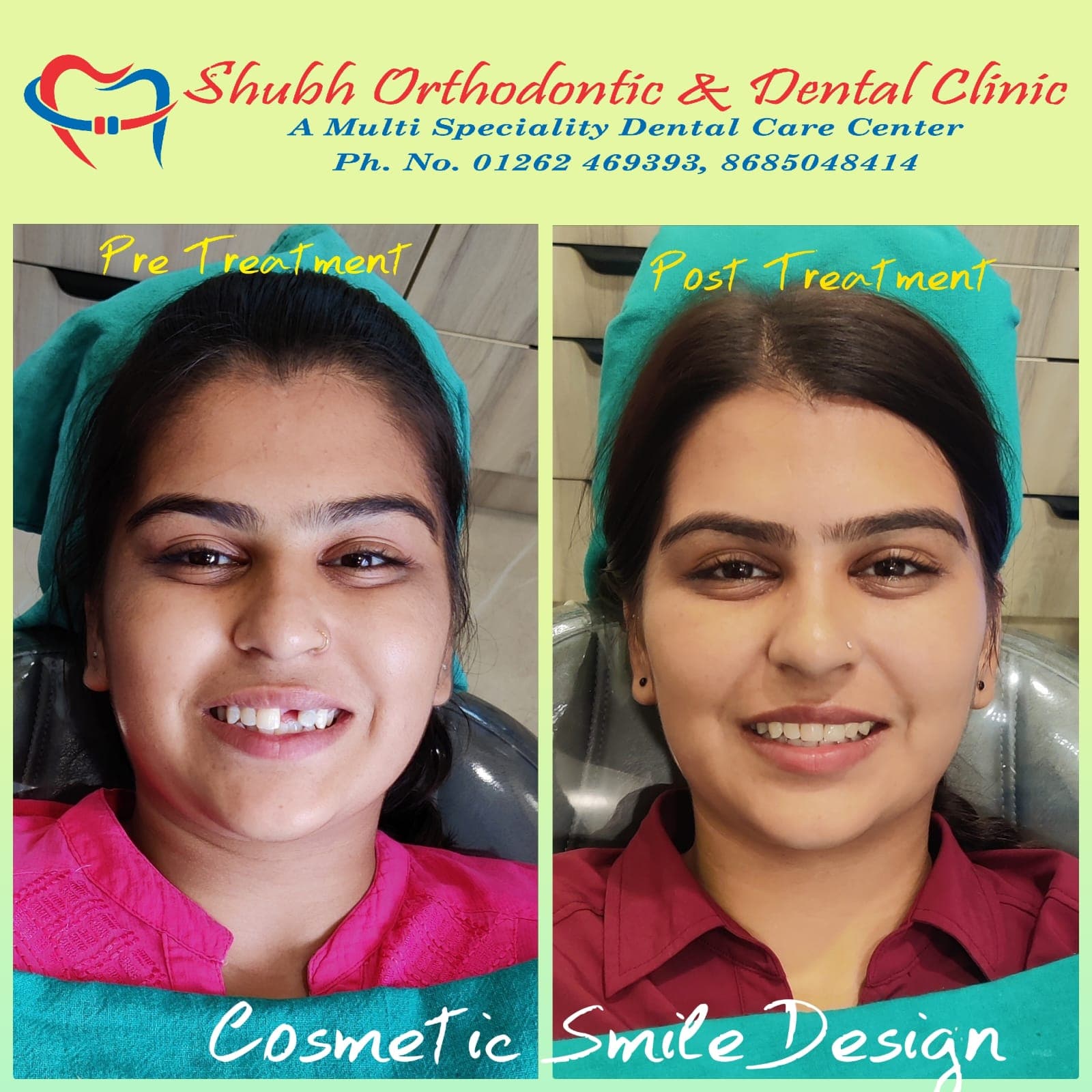 Smile Transformation #4