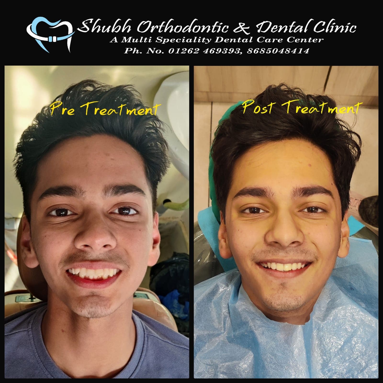 Smile Transformation #5