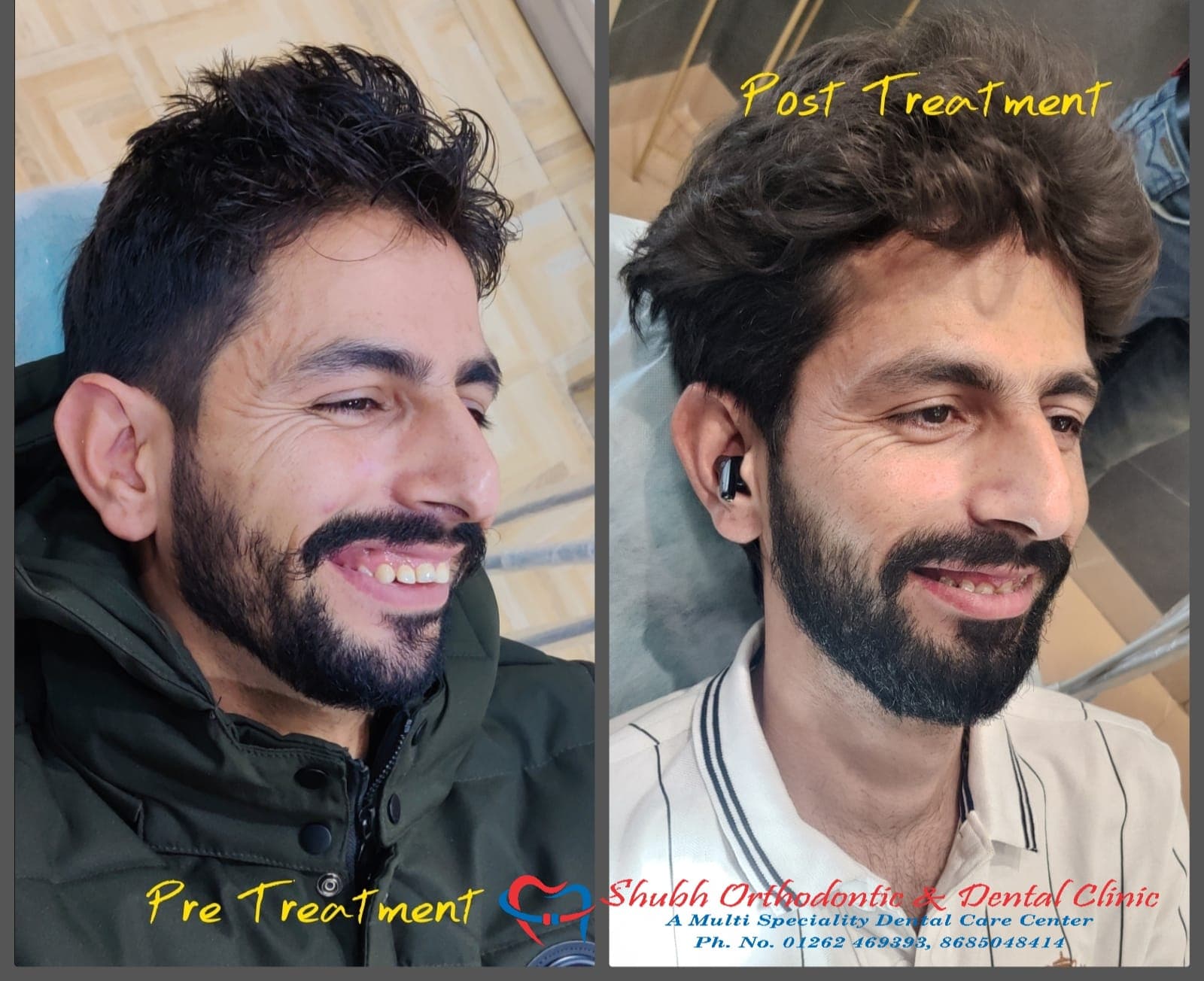 Smile Transformation #6